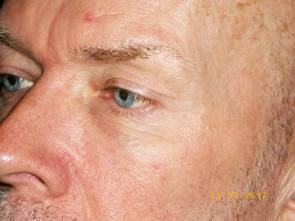 Male Eyelid Surgery