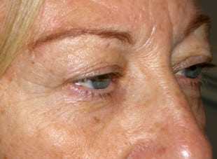 Patient 9 - Before View 