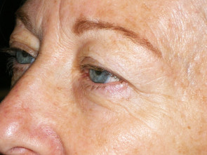 Female Eyelid Surgery