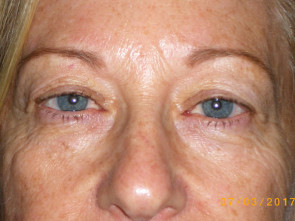 Female Eyelid Surgery