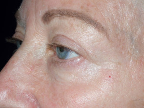 Female Eyelid Surgery