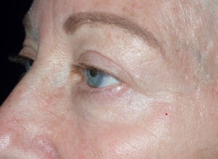 Patient 9 - After View 