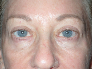 Female Eyelid Surgery