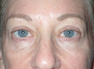 Patient 9 - After View 