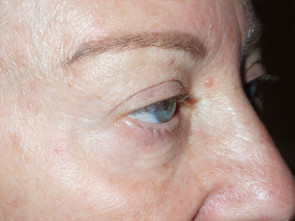 Female Eyelid Surgery