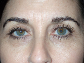 Female Eyelid Surgery