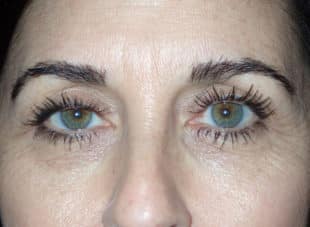 Patient 12 - Before View 