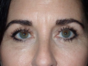 Female Eyelid Surgery