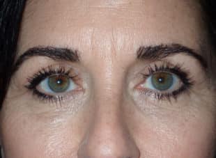 Patient 12 - After View 