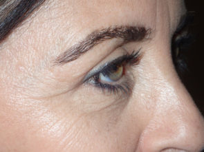 Female Eyelid Surgery