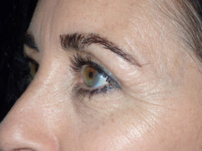 Female Eyelid Surgery