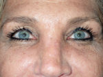 Female Eyelid Surgery