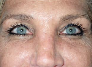Patient 11 - Before View 