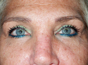 Female Eyelid Surgery