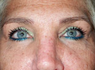Patient 11 - After View 