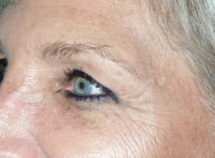 Patient 11 - Before View 