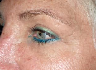 Patient 11 - After View 