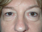 Female Eyelid Surgery