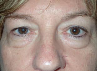 Patient 10 - Before View 