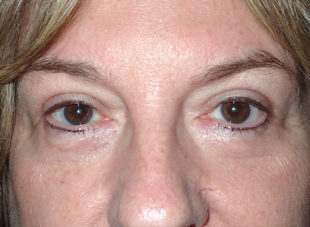 Patient 10 - After View 