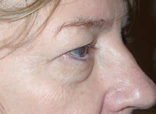 Patient 10 - Before View 