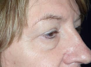 Patient 10 - Before View 