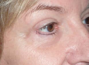 Patient 10 - After View 