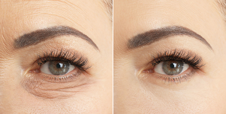 Lower Eyelid Cosmetic Transconjunctival Blepharoplasty and Lower Eyelid Bags Results