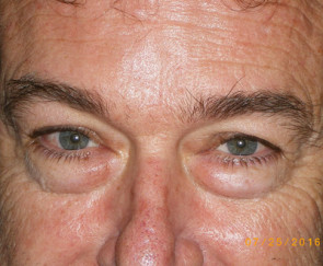 Upper Eyelid Surgery for Men Fort Lauderdale