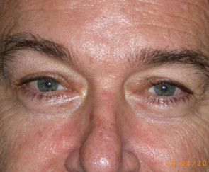 Upper Eyelid Surgery for Women Results Fort Lauderdale